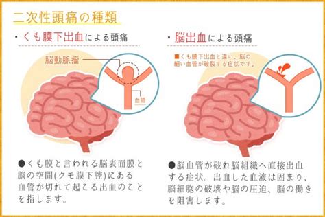 頭頂頭痛 原因|頭痛の種類まとめ～それぞれの違いと原因、症状、治。